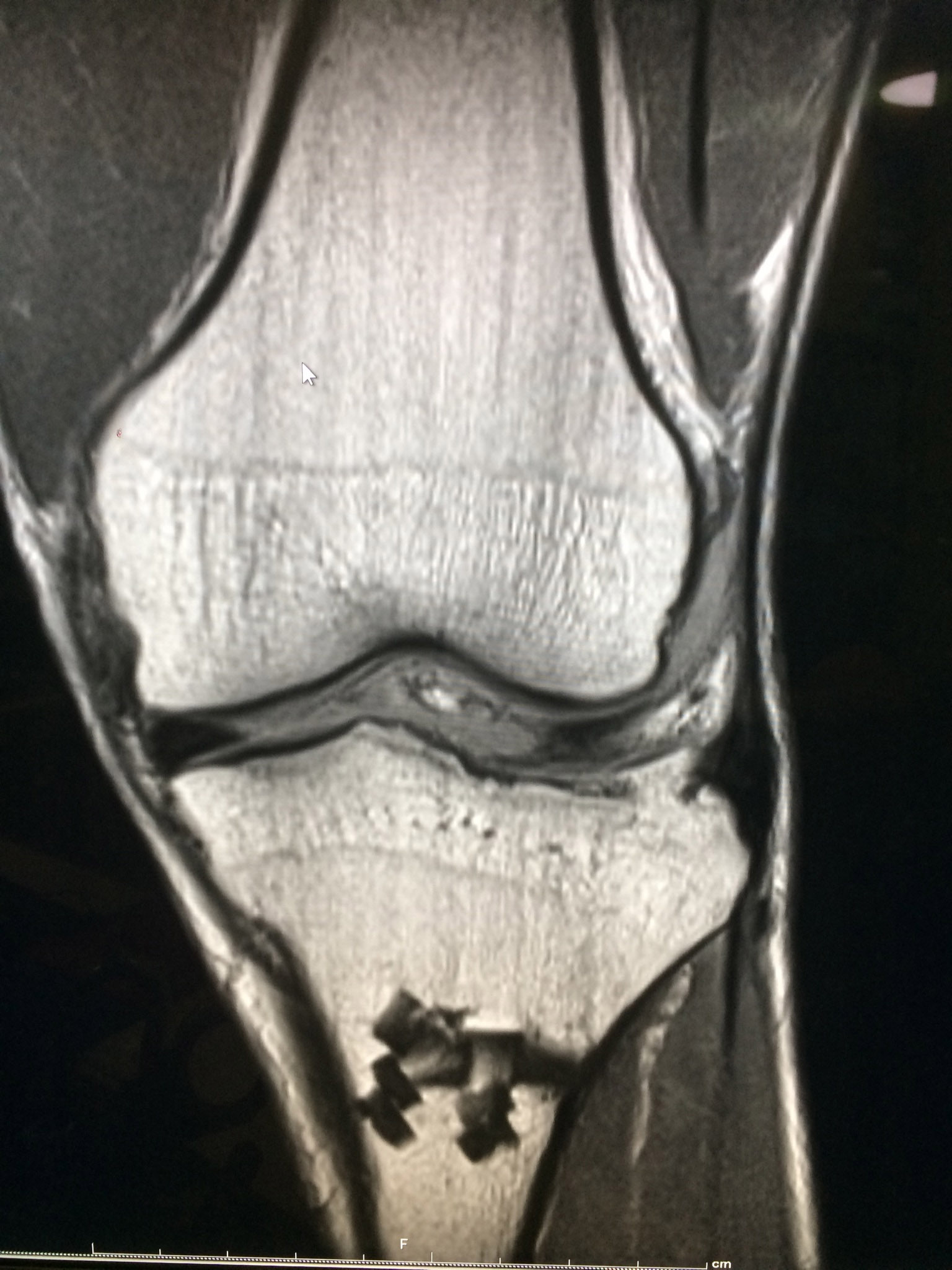 膝関節画像3
