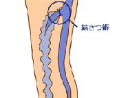 高位結紮（けっさつ）術