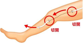 下肢静脈瘤と日帰り手術