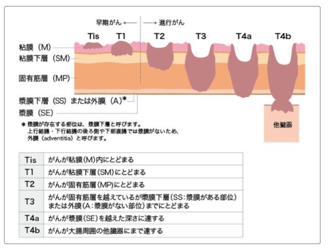 大腸がんとは 北青山dクリニック