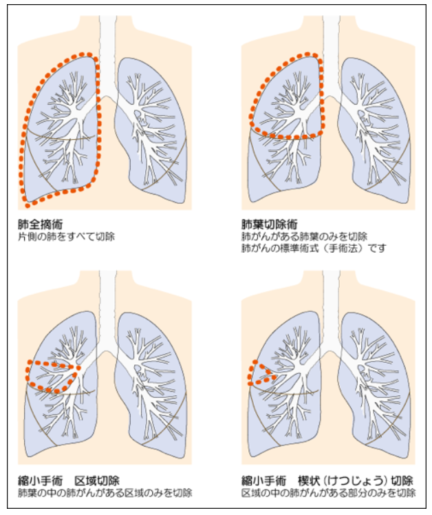 肺がんとは 北青山dクリニック 肺がんとは 北青山dクリニック