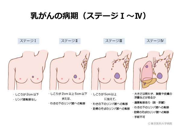 乳がんのステージ