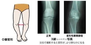 膝関節画像1