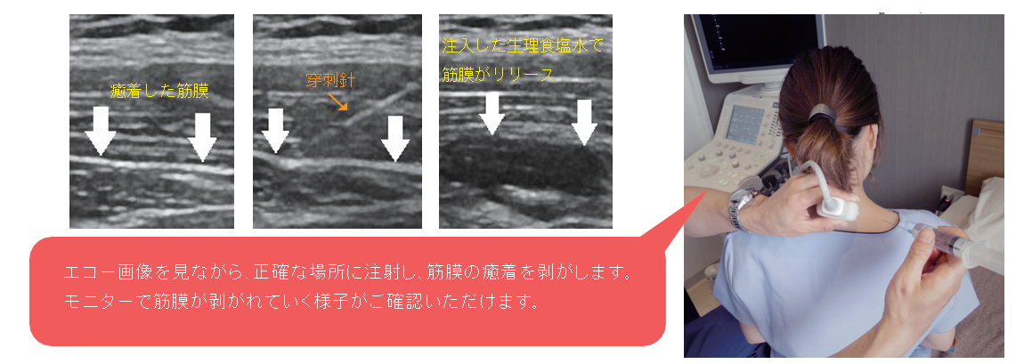 筋膜リリース注射イメージ