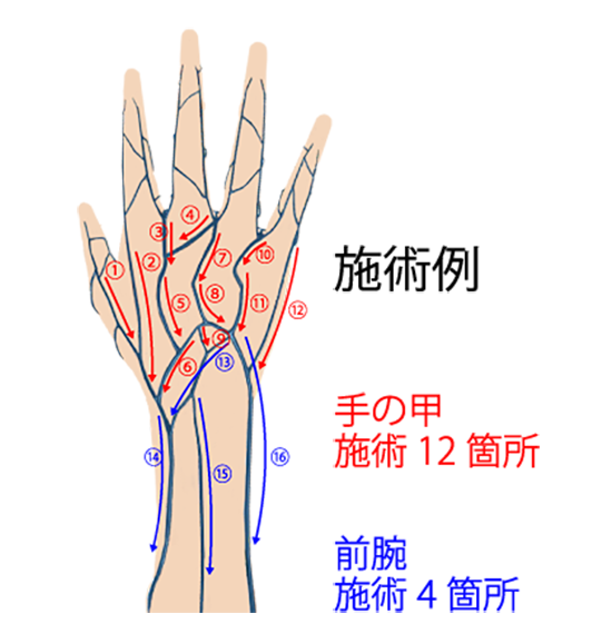 ハンドベイン施術例