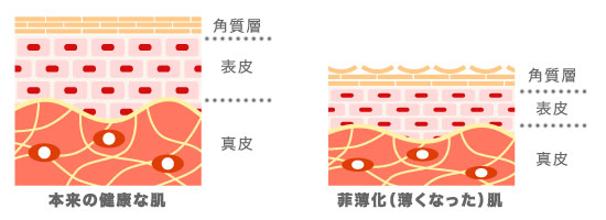 菲薄化した皮膚構造