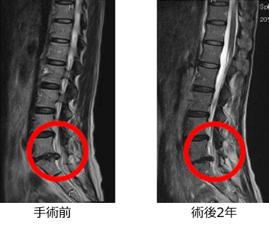 PLDD】50代女性 腰椎の椎間板ヘルニア 症例 19159 - 北青山D