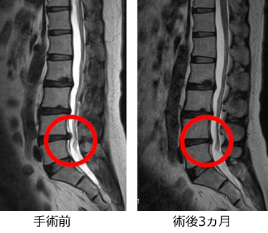 XLIF・OLIF側方経路腰椎椎体間固定術（Extreme Lateral
