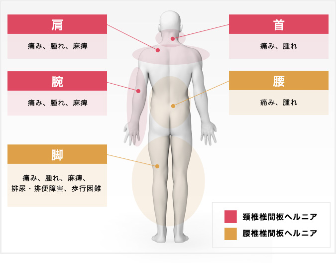 椎間板ヘルニアとは 北青山dクリニック 椎間板ヘルニアとは 北青山dクリニック