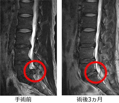 PLDD】30代男性 腰椎の椎間板ヘルニア 症例 25697 - 北青山D