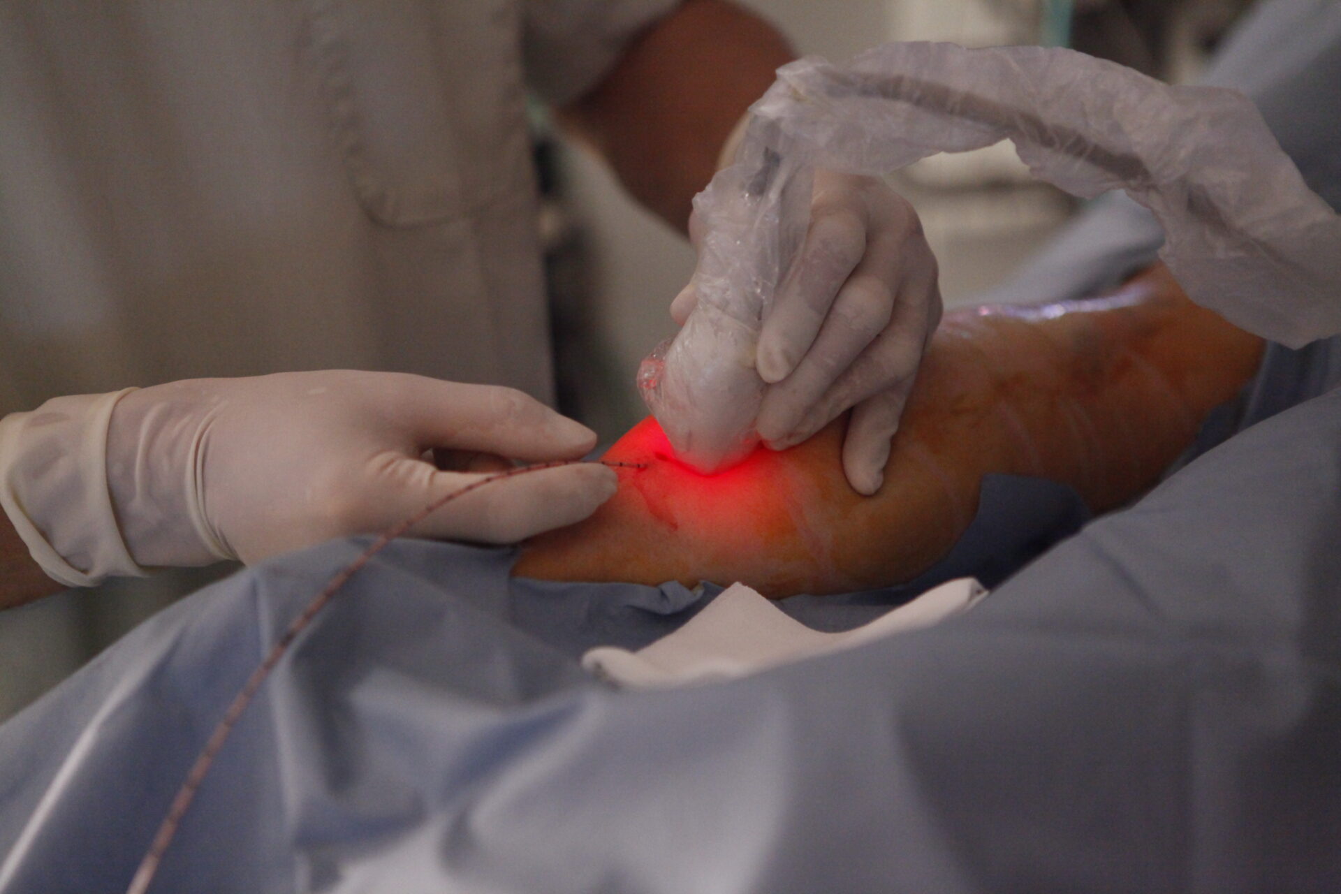 下肢静脈瘤手術の様子2