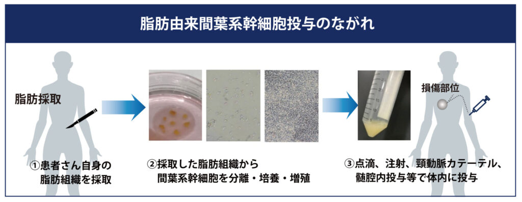 再生医療（幹細胞治療）投与の流れ