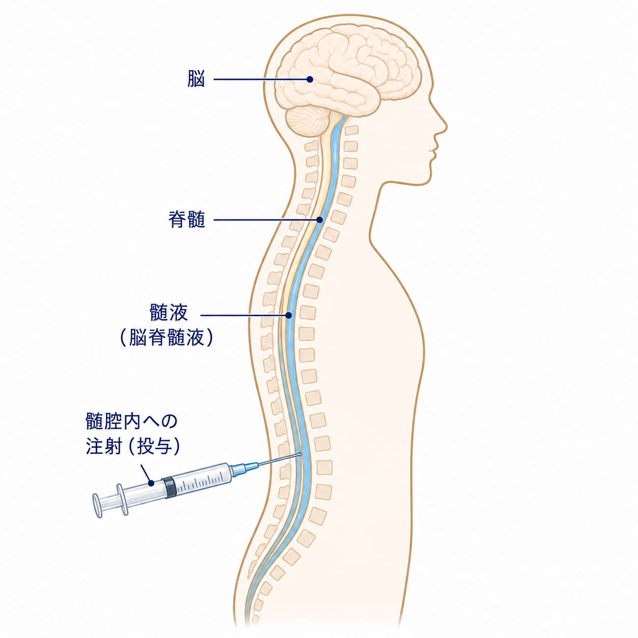 髄腔内投与のイメージ図（脳・脊髄・髄液の位置と、注射針による髄腔内注射の様子を示す図）